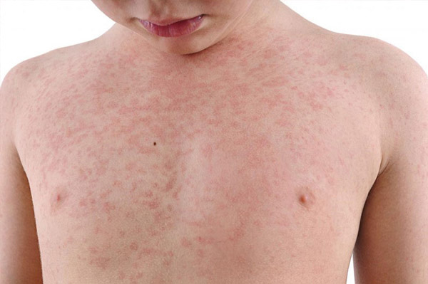 Biểu hiện đặc trưng bệnh sởi là phát ban đỏ trên da